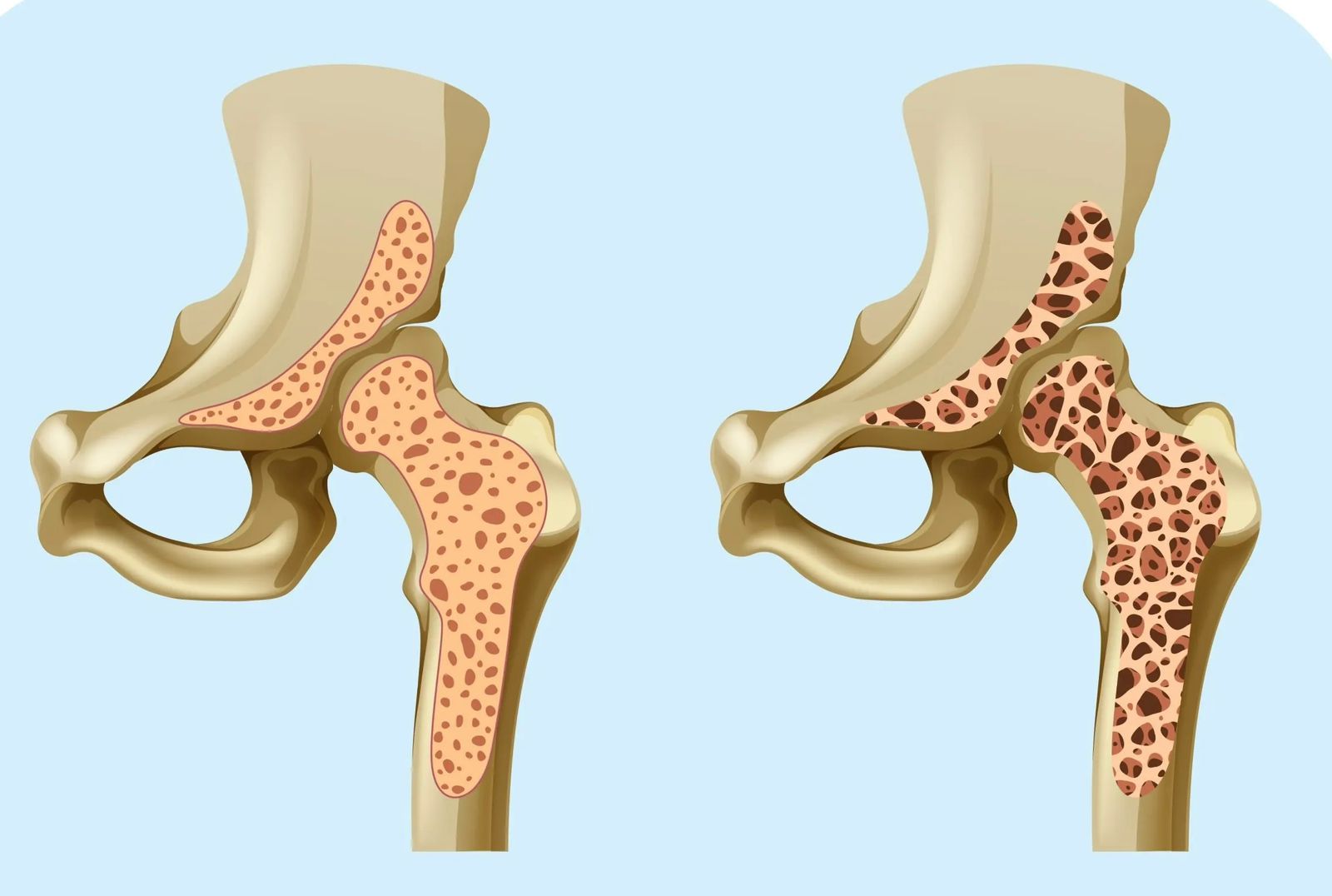 Doenças Metabólicas Ósseas — Osteoporose, Sarcopenia